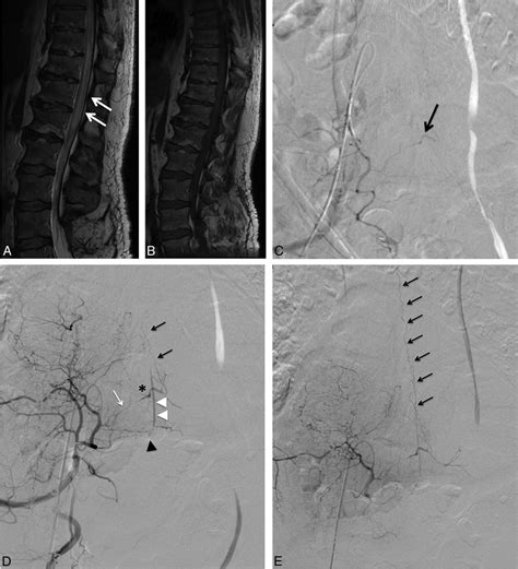 Anterior Spinal Artery Angiogram