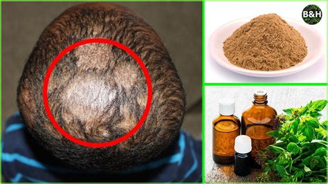 Ringworm Hair Loss Treatment How To Get Rid Of Scalp Fungus Instantly Tinea Capitis Youtube