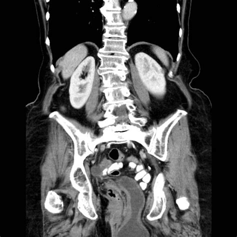 Urinary Bladder Hernia Through Pelvic Floor Image Radiopaedia Org