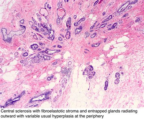 Pathology Outlines Radial Scar Complex Sclerosing Lesion