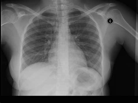 New AI Tool Accurately Detects COVID 19 From Chest X Rays