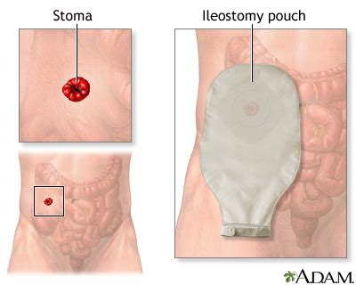 Ileostomy - UF Health