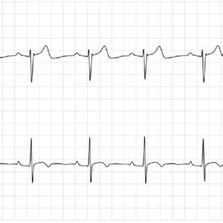 Holter Ekg Showing Sinus Rhythm On The Day Of Discharge Day Of