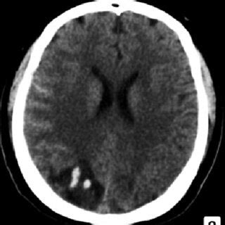 Tomograf A Axial Computarizada Cerebral Con Hemorragia Parietooccipital