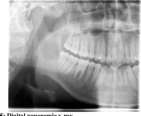 Figure From Odontogenic Keratocyst Of Mandible With An Unusual