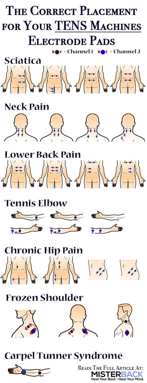 Tens Electrode Placement Chart Pdf