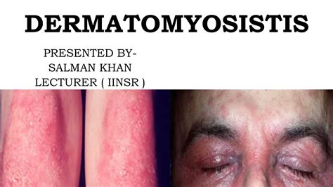 Dermatomyositis Pptx