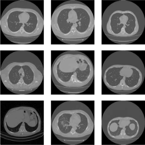 Samples from the Covid-19 CT scan dataset | Download Scientific Diagram