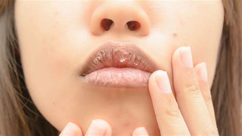 Here Are 4 Best Home Remedies To Soothe Dry Lips In Winter Get Rid Of