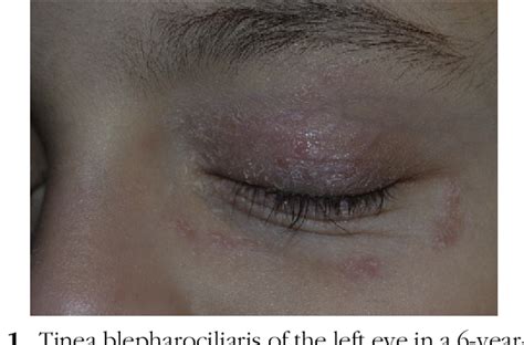 Figure From Trichoscopy Of The Eyelashes In Tinea Blepharo Ciliaris