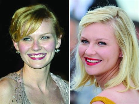 Kirsten Dunst Before And After Plastic Surgery