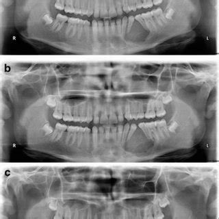 A Orthopantomogram OPG Radiograph Shows A Well Circumscribed