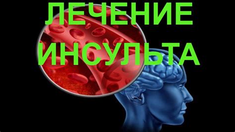 Лечение инсульта: 95 % успеха. Инсульт и его профилактика - YouTube