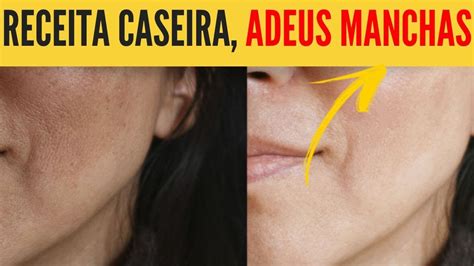 Receita Caseira Para Acabar Com As Manchas De Melasma Na Pele Youtube