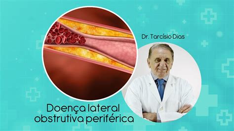 Doença Arterial Obstrutiva Periférica Youtube