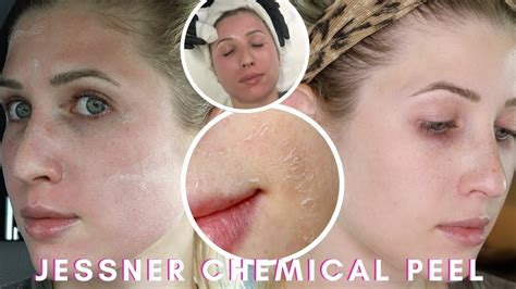 My Chemical Peel Experience Jessner Chemical Peel Youtube