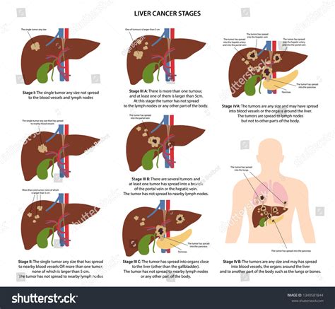 Four Stages Liver Cancer Description Corresponding 库存矢量图（免版税）1340581844 Shutterstock