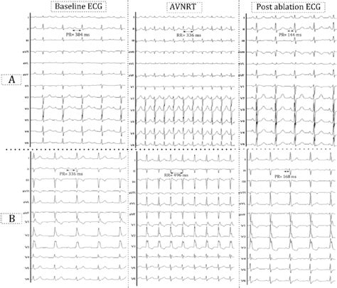 A And B Refer Respectively To Cases I And II Baseline ECG Shows A