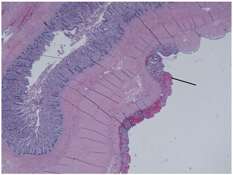 Intussusception Associated With A Meckels Diverticulum And A Duplication Cyst Journal Of