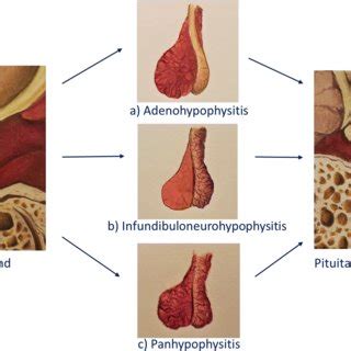 Diagram Of The Sella And Suprasellar Region Showing A Normal Pituitary