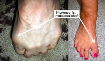 Mortons Toe | Foot Pain Care | PTI Orthotics | Boulder Longmont