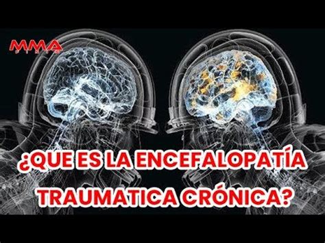 QUÉ ES LA ENCEFALOPATÍA TRAUMATICA CRÓNICA YouTube