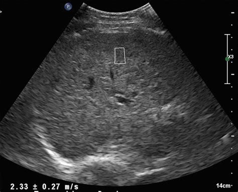 Liver Fibrosis Ultrasound