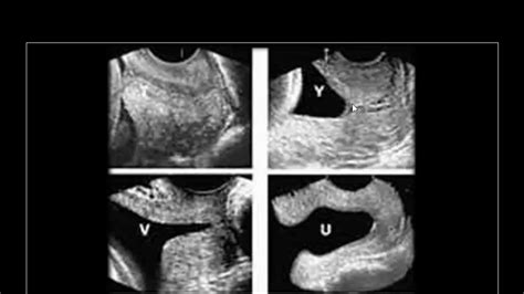 Translabial Ultrasound Cervix