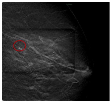 Tomography Free Full Text Vascular Complications Following Vacuum