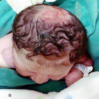 A Aplasia Cutis Congenital Of The Scalp Skull And Dura The