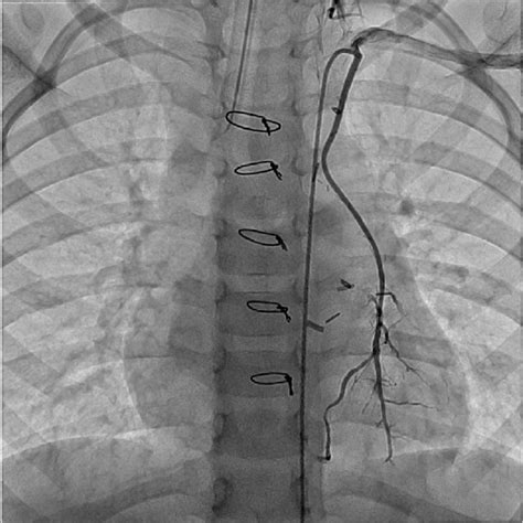 Postoperative Cardiac Computed Tomography Angiography With