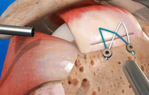 Cirurgia Para Reparo Do Manguito Rotador Guia Completo Para O Sobre O