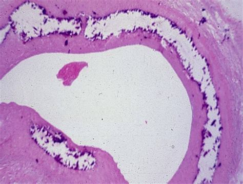 Arteriosclerosis Ischemic Heart Disease Pathology Flashcards Quizlet