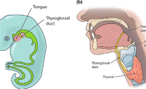 Thyroglossal Duct Cysts Anatomy Embryology And Treatment Semantic ...