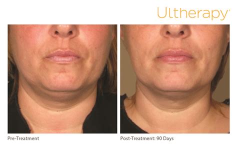 Ultherapy Before After Photos Medspa Folsom El Dorado Hills