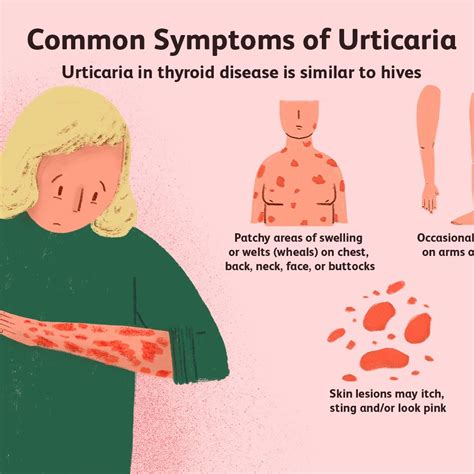 Hypothyroidism Dry Skin