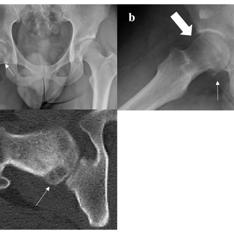 Pathological Findings A Low Power View Showing That The Tumor