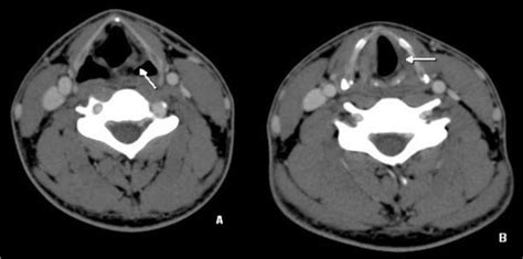 Figure From Cadaveric Position Of Unilateral Vocal Cord A Case Of