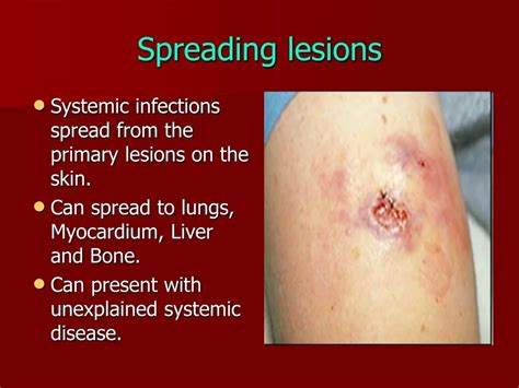 understanding melioidosis  comprehensive guide powerpoint