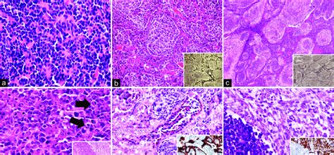 Histoloical Subtypes Of Medulloblastoma Classic Medulloblastoma With