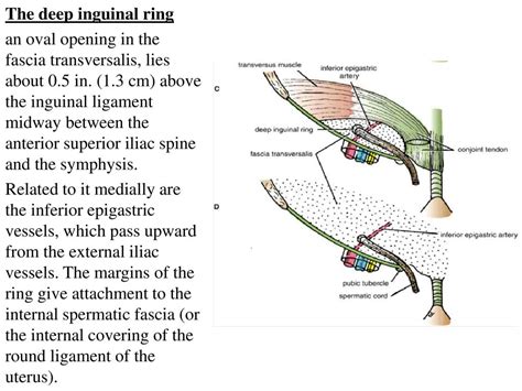 Details more than 56 location of deep inguinal ring - vova.edu.vn