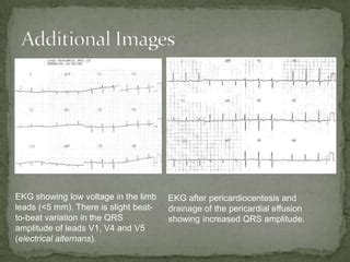 Pericardial effusion | PPT