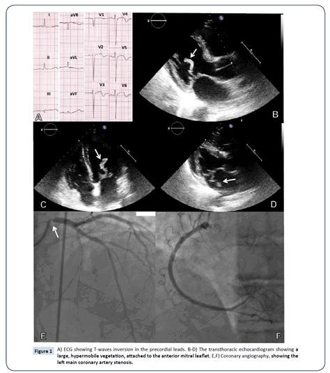 Endocarditis Ecg