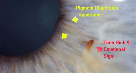 Pigmentary Dispersion Syndrome