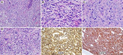 The Reexcised Tumor Exhibits Multiple Morphologic Components A