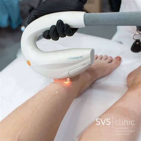 Фотоэпиляция