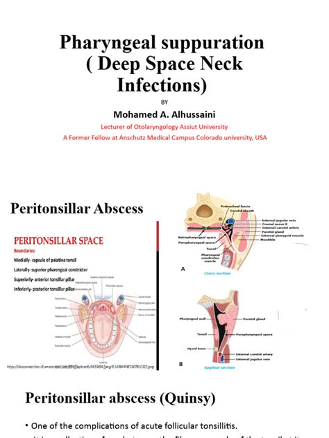 peritonsillar  parapharyngeal abscesses  pneumonia medical