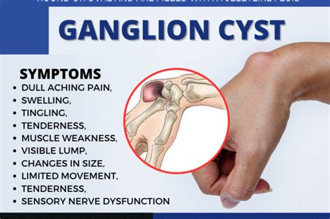5 Natural Remedies To Banish Ganglion Warts From Your Wrist