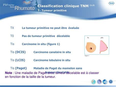 Classification Tnm Cancer Sein Outlet 100 Brunofuga Adv Br