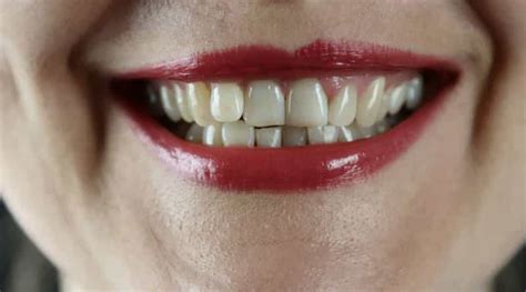 4 Popular Teeth Whitening Methods and Their Risks | HealthtoStyle